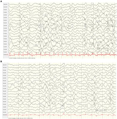 Intrafamilial neurological phenotypic variability due to either biallelic or monoallelic pathogenic variants in CACNA1A